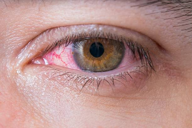 Coronavirus and your eyes: What you need to know | Eye Medical